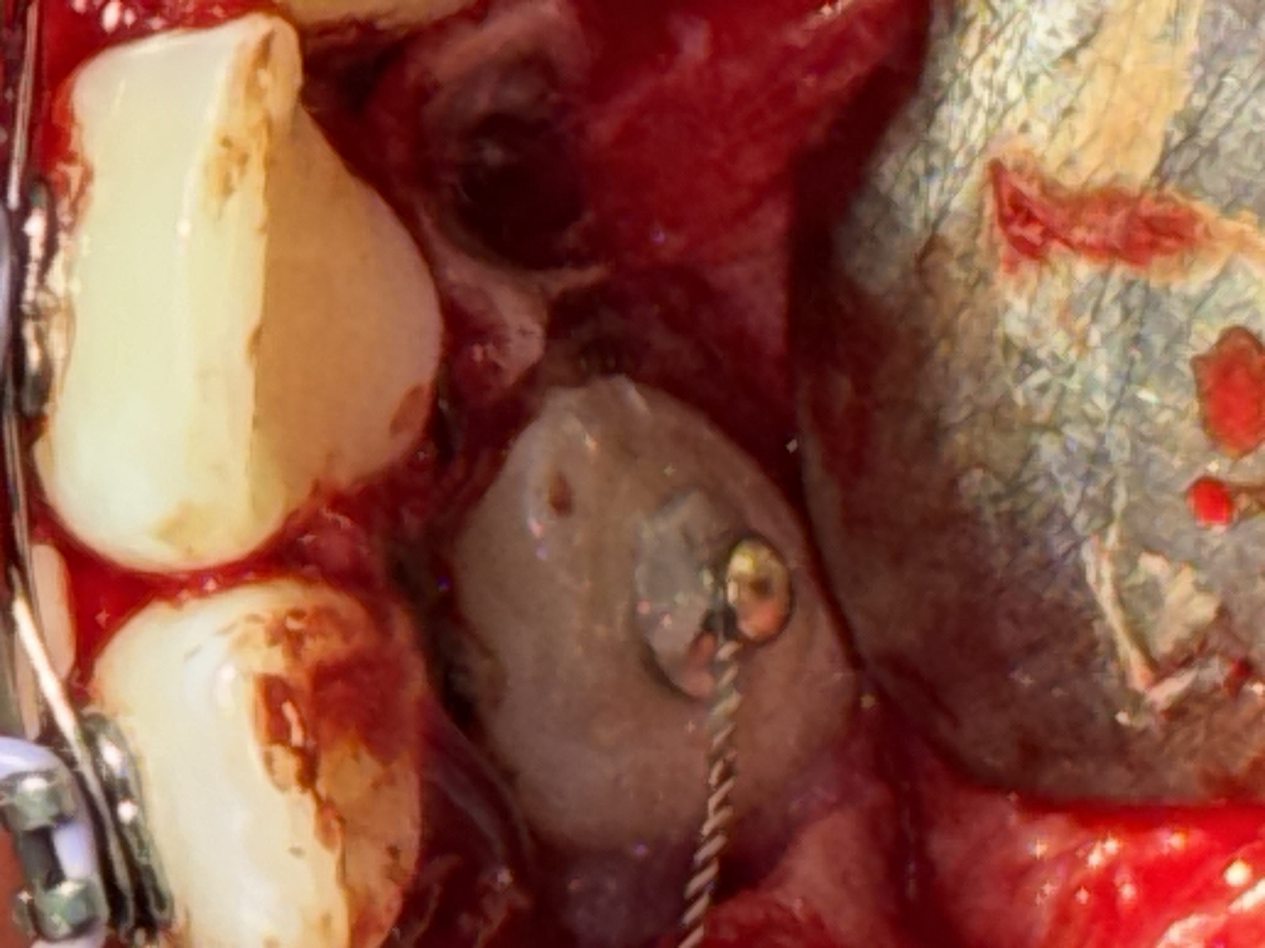 Fenestración canina palatina